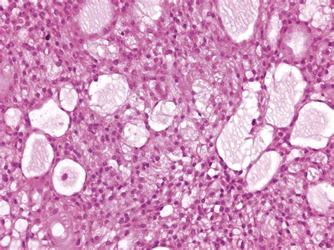 Stromal Tumours Of The Ovary An Update Diagnostic Histopathology