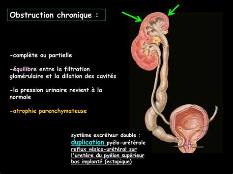 Ppt Imagerie Et Obstruction Urinaire Powerpoint Presentation Id