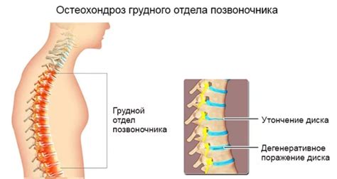 Остеохондроз грудного отдела ⋆ vertebrology.ru