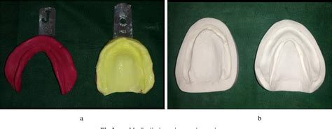 Figure From Prosthodontic Management Of Flabby Tissue Using Modified