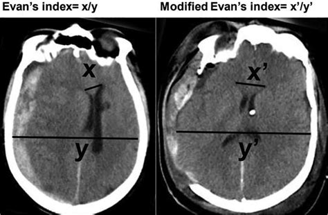 Accuracy Of Freehand External Ventricular Drain Placement In Patients