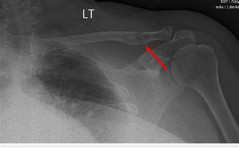 Chest X Ray Revealed A Non Displaced Fracture Of Her Left Clavicle