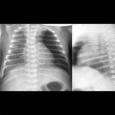 Premature infant with respiratory distress on a ventilator | Pediatric