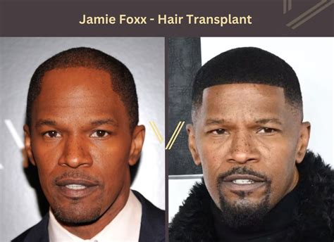 Black Celebrity Hair Transplant 27 Before And After Photos