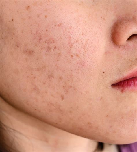 Melasma Laser Treatments In New York Byou Laser Clinic