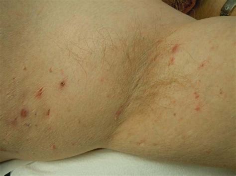 Hidradenitis Suppurativa