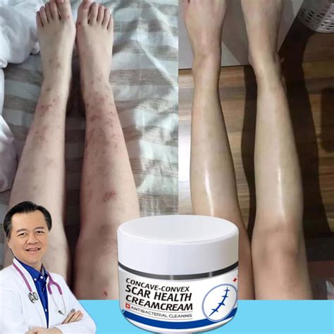 Authentic Scar Remover For Old Scar On Leg Stretch Mark Remover