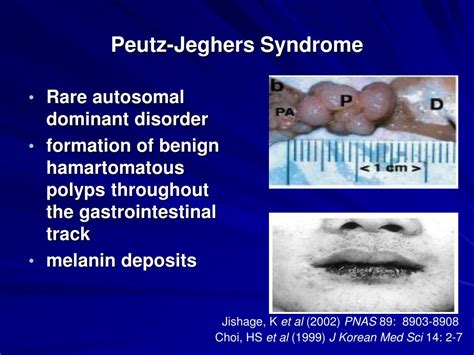 peutz jeghers syndrome lbkstk powerpoint