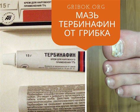 Грибок ногтей мазь: список, как выбрать, рецепты, аналоги, отзывы