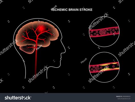 Ischemic Brain Stroke Normal Artery Arteriosclerosis Stock Vector