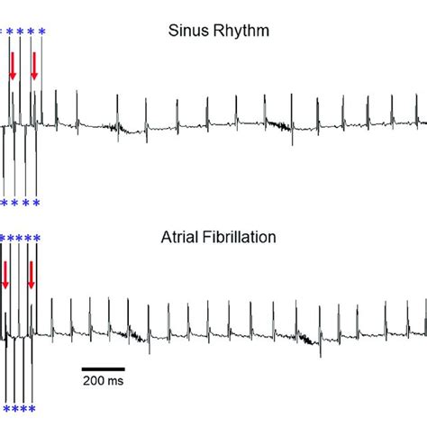 Induction Of Af During Transesophageal Atrial Pacing Surface Ecg Download Scientific Diagram