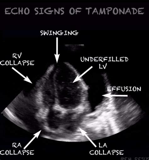 Do you know about Cardiac Tamponade?? – Platform | CME