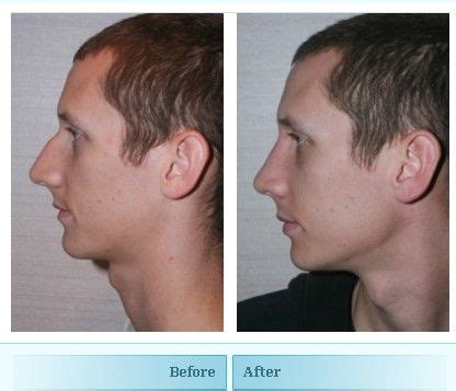 Male Nose Job Before And After Damn It Biog Frame Store