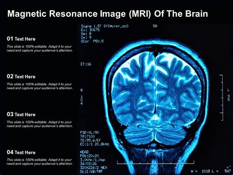 Magnetic Resonance Image Mri Of The Brain Presentation Graphics