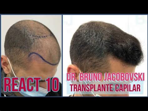 React Transplante Capilar Dr Bruno Jacobovski Youtube