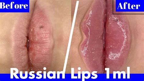 Powiekszanie Ust Kwasem Hialuronowym Russian Lips Ml Medycyna