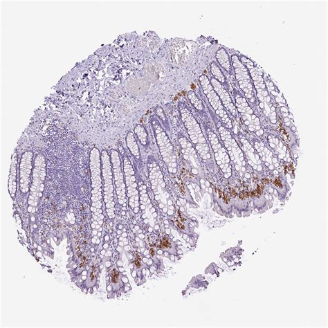 Tissue Expression Of Cd68 Staining In Colon The Human Protein Atlas