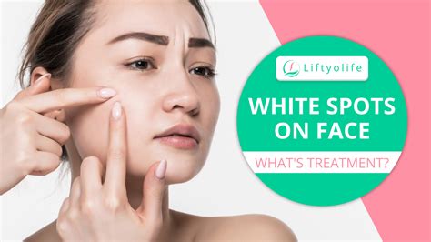 White Spots On Face Types Causes Symptoms And Treatments Images | Hot ...