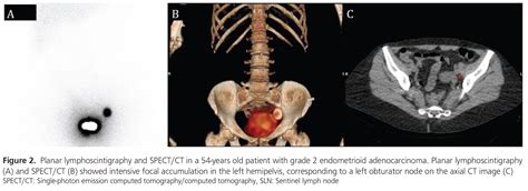 The Evaluation Of Sentinel Lymph Node Biopsy Using Radiocolloid In