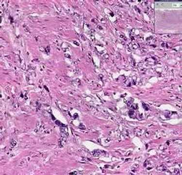 Esophageal Squamous Cell Carcinoma Histology