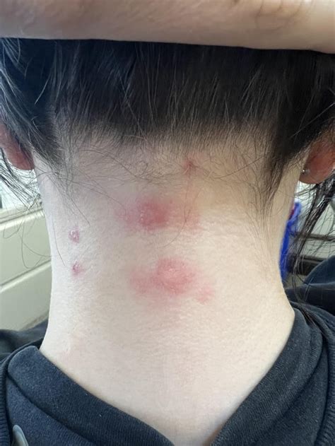 Can shotty lymph nodes grow if I bug them ? : r/lymphnodes