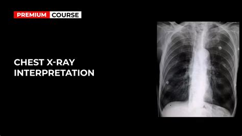 Interpreting A Chest X Ray Abcde At Helen Breen Blog