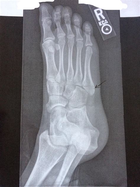 Another Pseudo Jones Fracture R Radiology