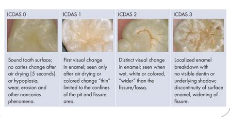 Icdas Radiographic Scoring System