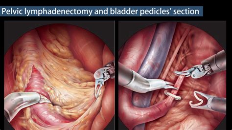 Robotic Radical Cystectomy Female Youtube