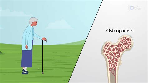 Role of Vitamins in Maintaining Bone Health | Anatomy and Physiology | JoVe