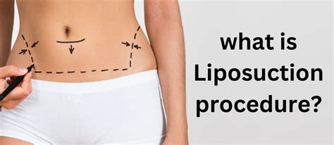 What Is Liposuction Procedure And How Does It Reduce Extra Fat