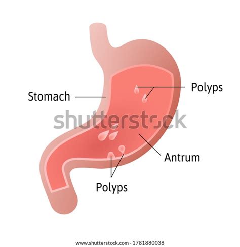 Gastric Polyps Masses Cells That Form Stock Vector Royalty Free 1781880038 Shutterstock