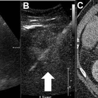 52 Year Old Man With Hepatitis C Underwent Biopsy Patient Was First