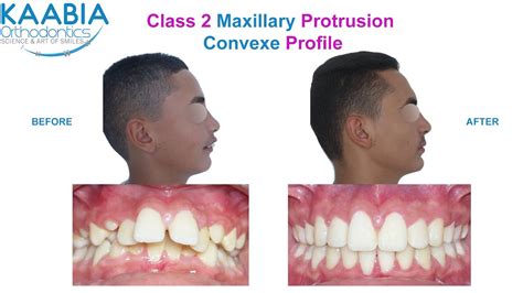 Class2 Maxillary Protrusion Excessive Over Jet Deep Bite Proalvéolie