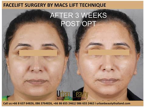 MACS Lift Facelift Thailand Urban Beauty Thailand