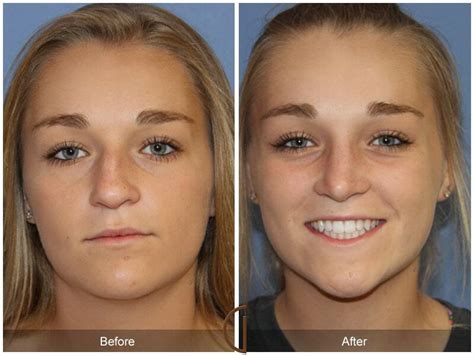 Female Rhinoplasty Before After Photos Patient Dr Kevin Sadati