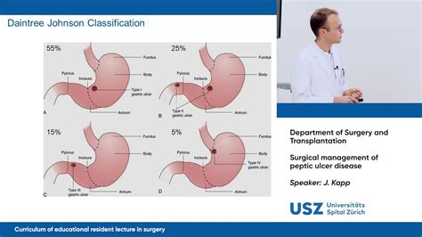 Gastric Ulcer Classification