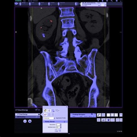 Syngo CT DE Calculi Characterization Siemens Healthineers