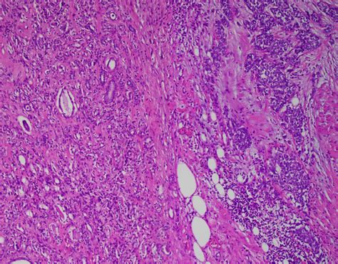 Breast And Axillary Metastases From Transitional Cell Carcinoma Of The