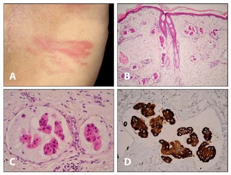 A A Solitary Oval Shaped Annular Erythematous Plaque In The Left