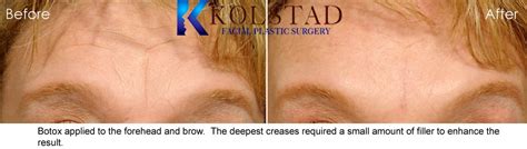 Natural Forehead Botox Before & After Gallery 32 | Dr. Kolstad - San Diego Facial Plastic Surgeon