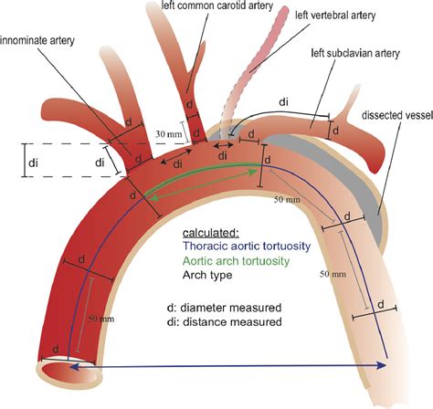 aortic arch anatomy  candidates  aortic arch repair seminars