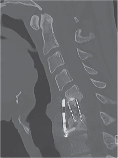 Spinal Infections Musculoskeletal Key