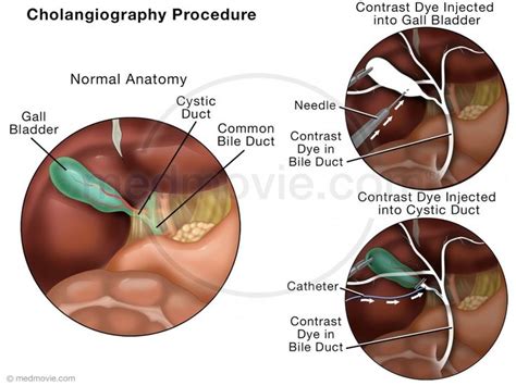 Cholangiography Procedure Medical Coding Procedure Bile Duct