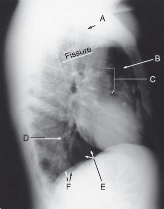 Lateral Chest X-Ray Diagram | Quizlet