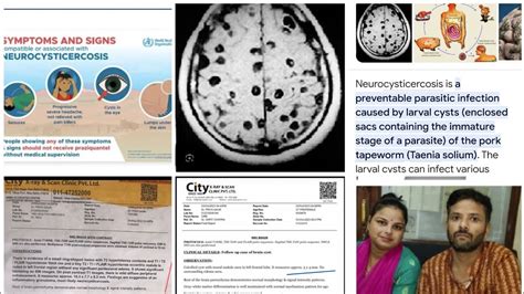 Neurocysticercosis Responded And Cured By Dr Arpit Chopra Jain Modern Homoeopathy Saved