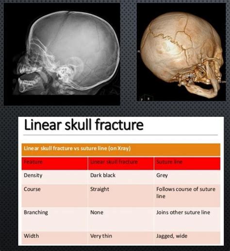 Skull Fracture Calcification