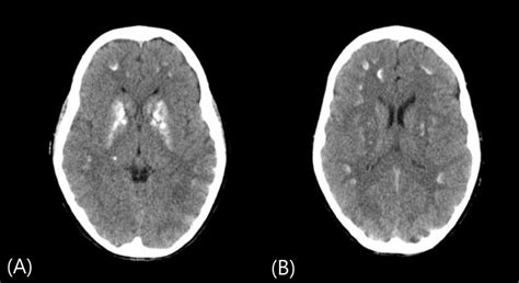 A B Cranial Computed Tomography Scan Shows Multiple Calcifications