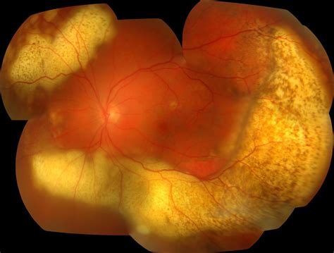 Primary Intraocular Lymphoma Survey Of Ophthalmology