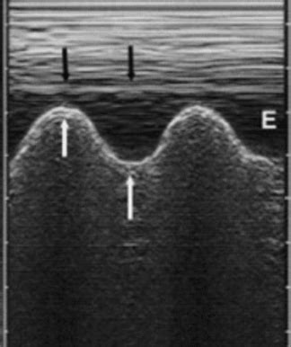 Sinusoid Sign Lung Ultrasound